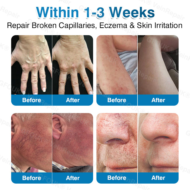 VeinRepair Microneedle Patch Roll⚡Instant Relief, Long-Term Results