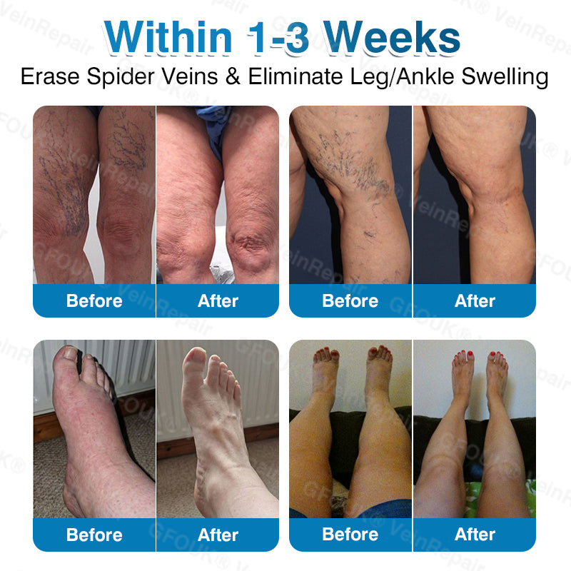 VeinRepair Microneedle Patch Roll⚡Instant Relief, Long-Term Results