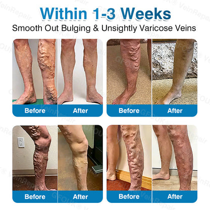 VeinRepair Microneedle Patch Roll⚡Instant Relief, Long-Term Results